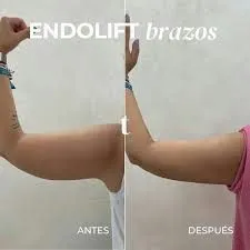 Endolift corporal: redefinir contornos con estética urbana y natural